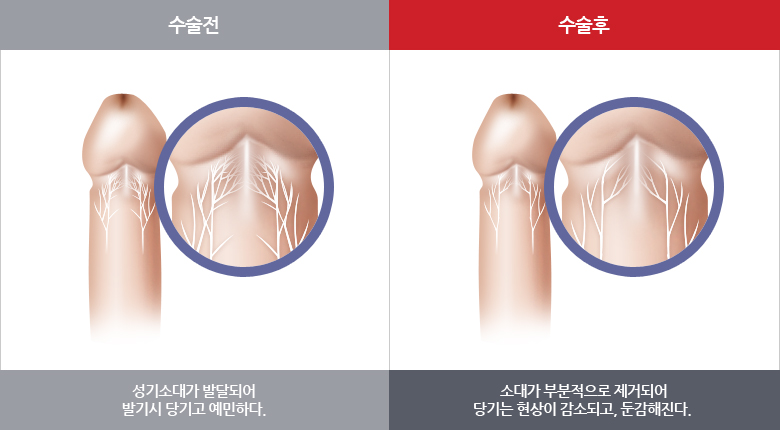 소대차단술 전후