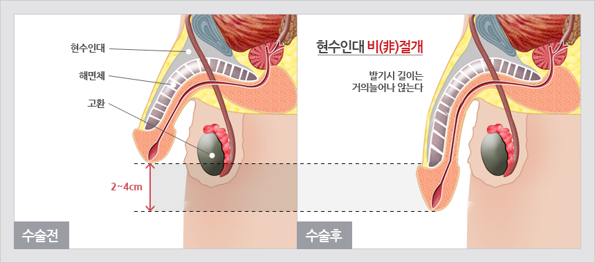 리드엠의 현수인대 비절개식 길이연장