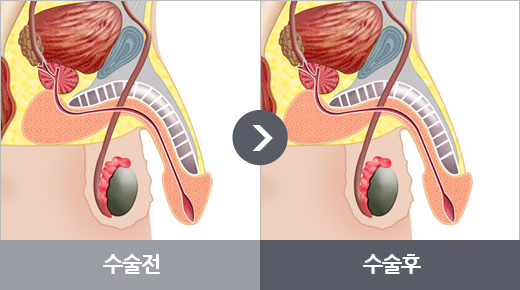 정관수술 과정